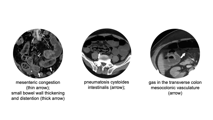 Among the CT cases, the authors found 31% of the  #COVID19 cases showed bowel wall abnormalities. In particular, 20% of CTs done in ICU patients showed pneumatosis and/or portal venous gas. Some of the patients taken for ex-lap had bowel necrosis, but not all. 13/19