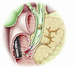 gastroentrolog2's tweet image. #Endoscopic retrograde #cholangiopancreatography (ERCP) is used primarily to #diagnose and treat conditions of the #bile #ducts and main #pancreatic duct, including gallstones, inflammatory strictures (scars), leaks (from trauma and surgery), and cancer.