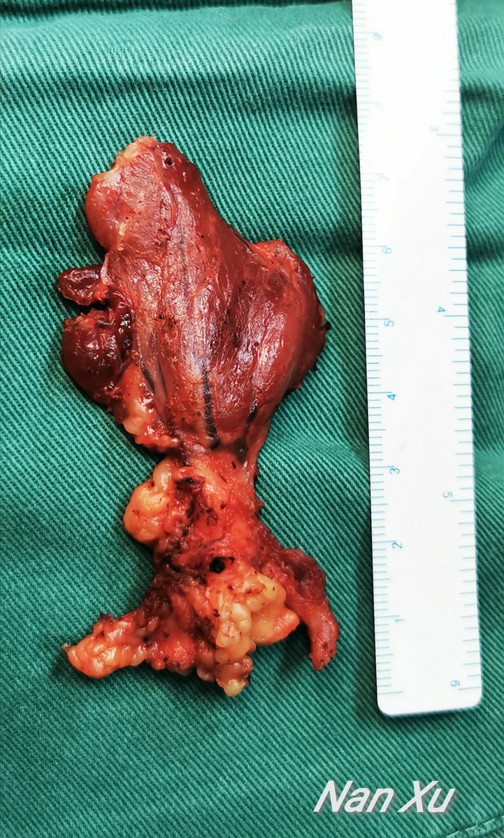 The Transoral Endoscopic Thyroidectomy with Vestibular Approach (TOETVA) for the Treatment of Thyroid Carcinoma