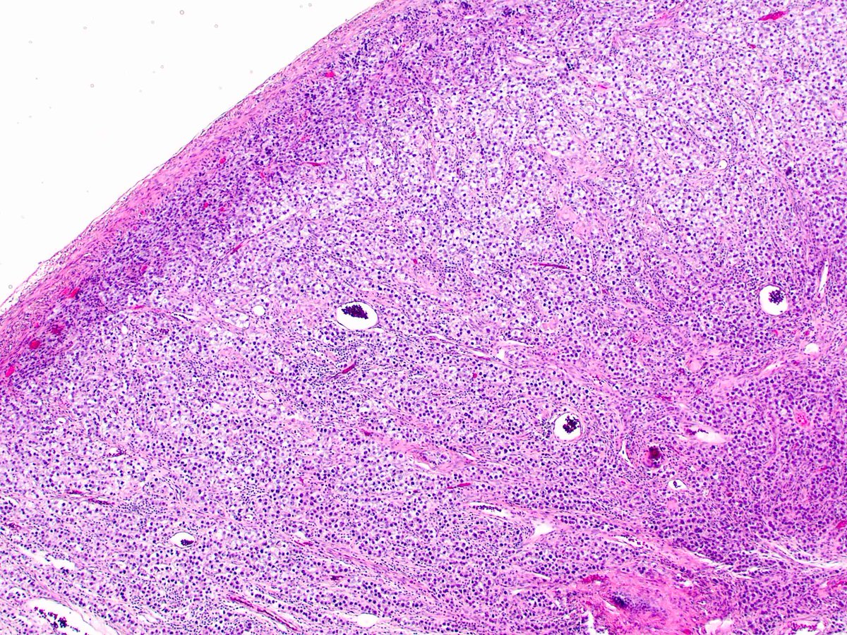 UABPathology's tweet photo. Case of the week submitted by Dr. Yemelyanova. The patient is a 18 year old female with bilateral adnexal masses. https://t.co/g7KegT3MSW