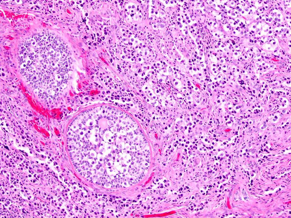 Case of the week submitted by Dr. Yemelyanova. The patient is a 18 year old female with bilateral adnexal masses.