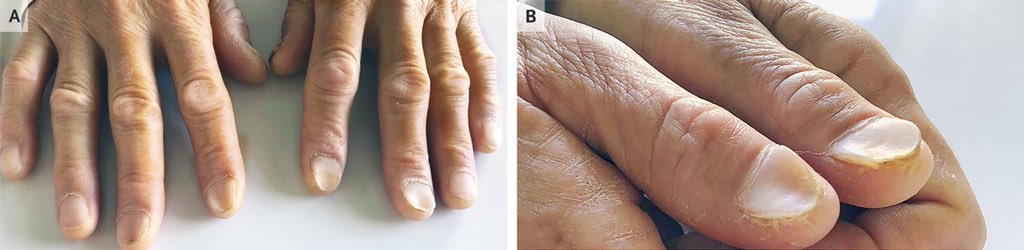 爪がでこぼこに 原因は 治し方は ネイルはできる 移動式ネイルサロン Serinail
