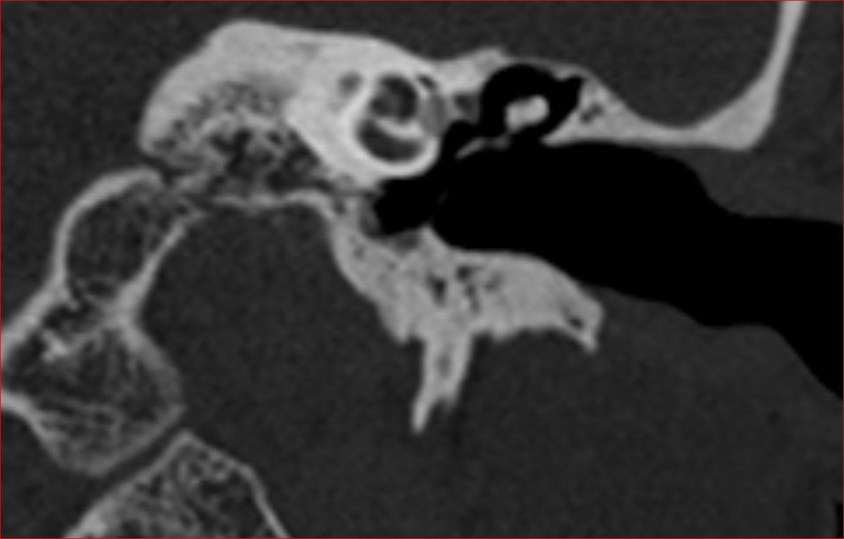 Checkout this weeks interesting case. 
Visit bit.ly/3gFDQzv

@CARadiology

@CChadaga

#radres #MedEd #FOAMrad #FOAMed #temporalbone #ENT #NeuroRad  #Neuro #MedTwitter  #CARG #CARGCOTW