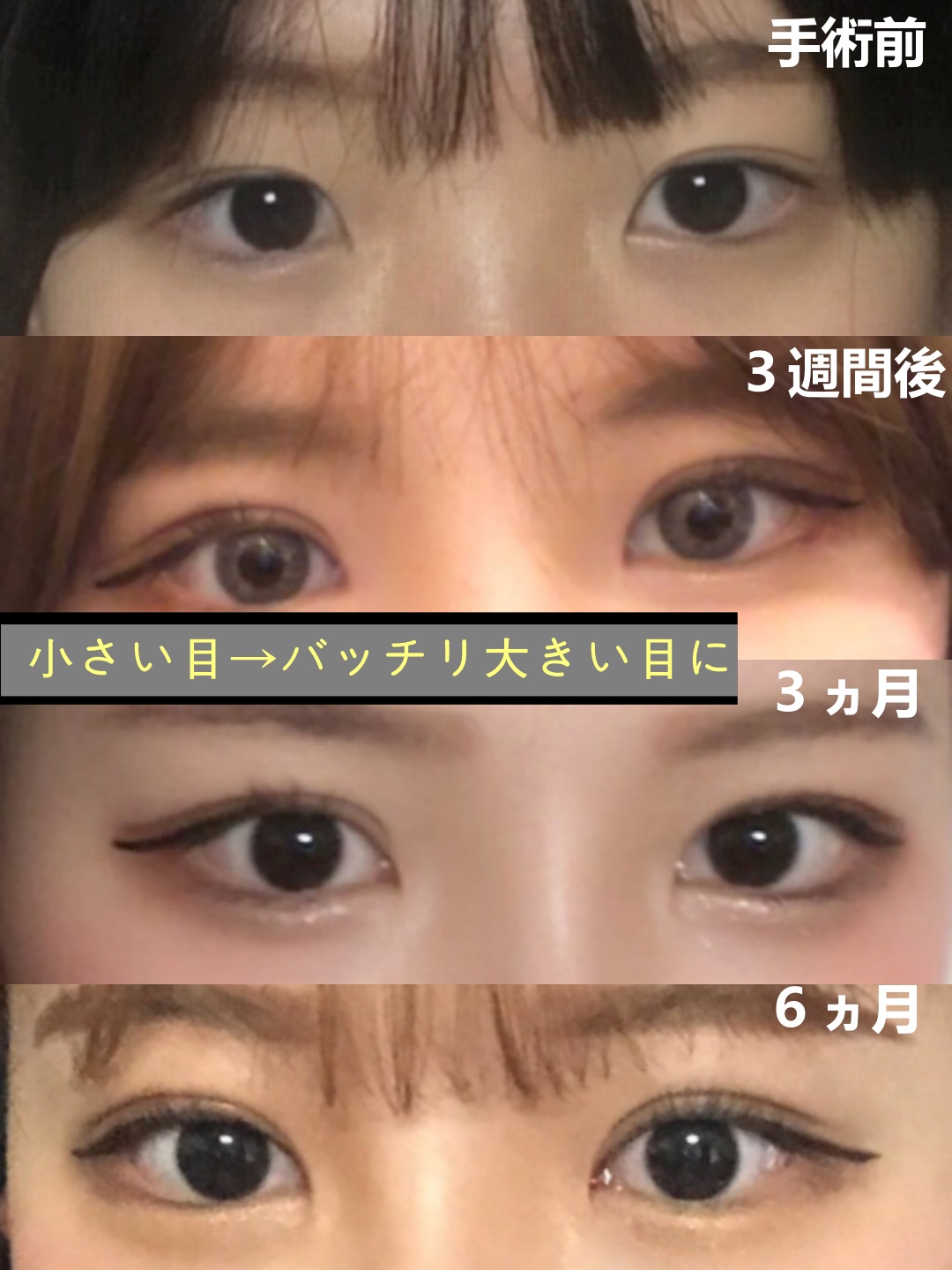 トップフェイス整形外科 日本公式 Topface 目頭の 蒙古皴 で目が小さく見えますでしょうか 目総合項目 目のすっかり感を出すために 二重自然癒着 目頭切開 目をもっと大きく演出するために デュアル開き 目尻切開 トップフェイス整形外科 日本公式 Topface 目頭の 蒙古皴 で目が小さく見えますでしょうか 目総合項目 目のすっかり感を出すために 二重自然癒着 目頭切開 目をもっと大きく演出するために デュアル開き 目尻切開