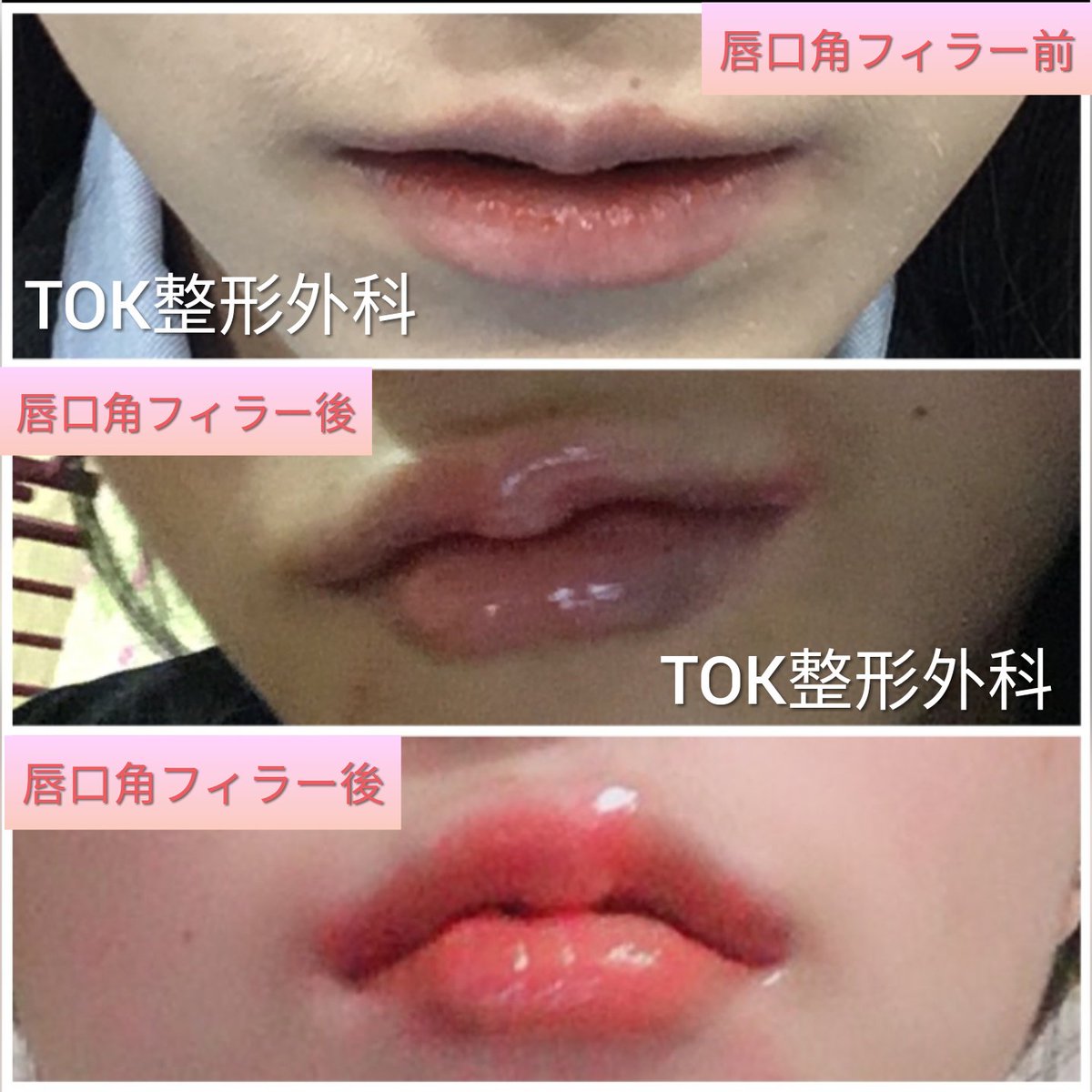 涙袋フィラー