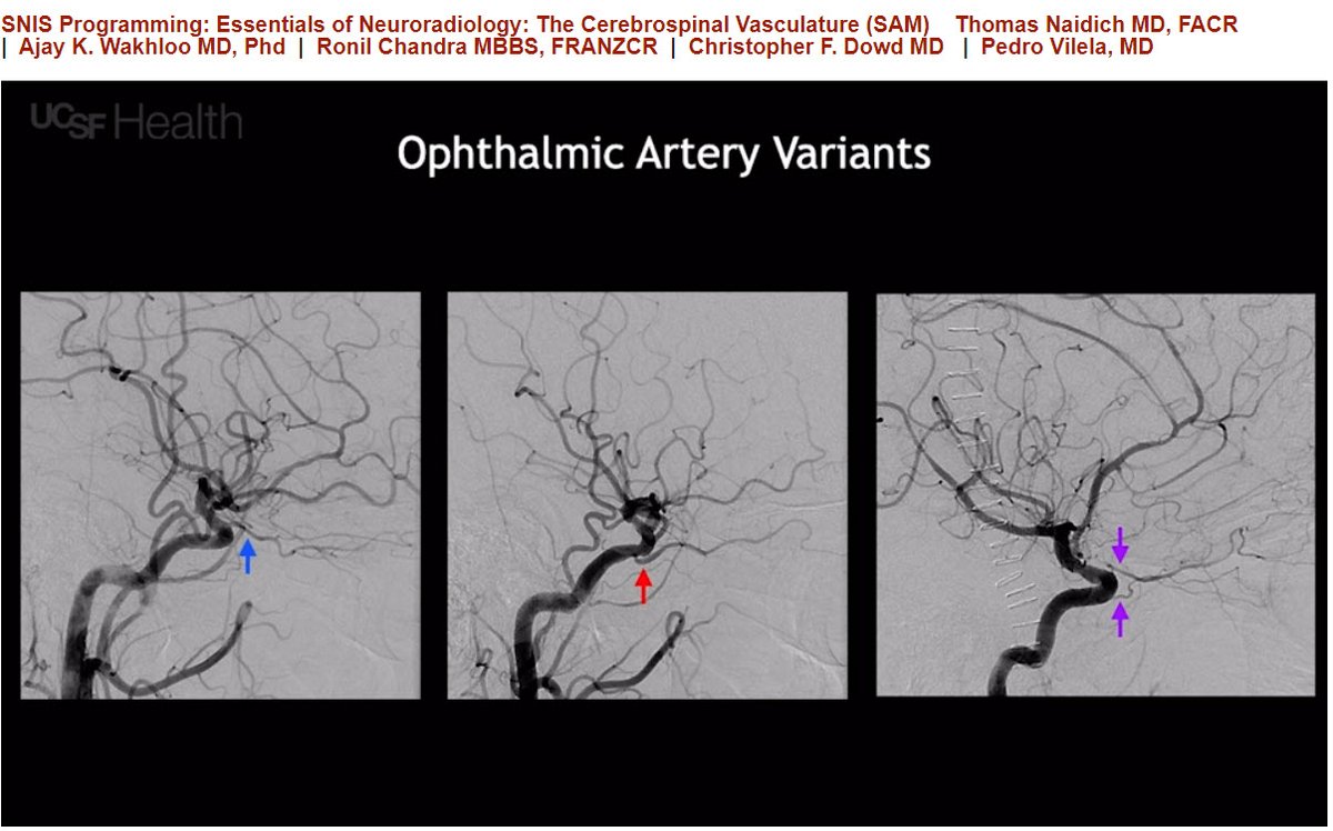 Stephen R Chen (@s0schen) on Twitter photo Cool Cerebrovascular Cases! Great talk by Dr. Christopher Dowd <a href="/UCSFMedicine/">UCSF School of Medicine</a> Duplicated ophthalmic origin! #ASNR20 #distancelearning Cool Cerebrovascular Cases! Great talk by Dr. Christopher Dowd <a href="/UCSFMedicine/">UCSF School of Medicine</a> Duplicated ophthalmic origin! #ASNR20 #distancelearning