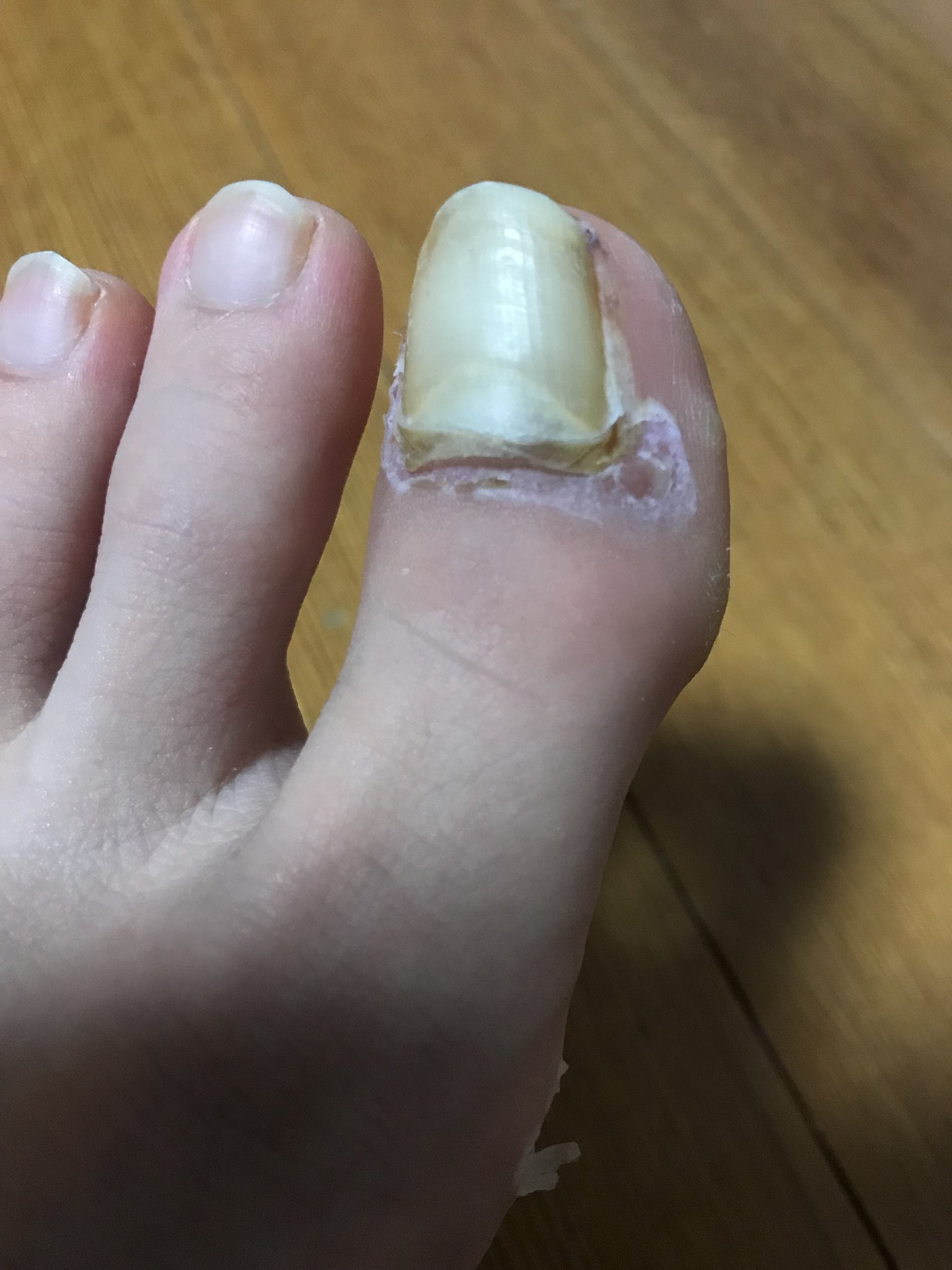 きたりぃ 閲覧注意 足 汚い 足の爪取れそう T Co 6lwg8qpnoe Twitter