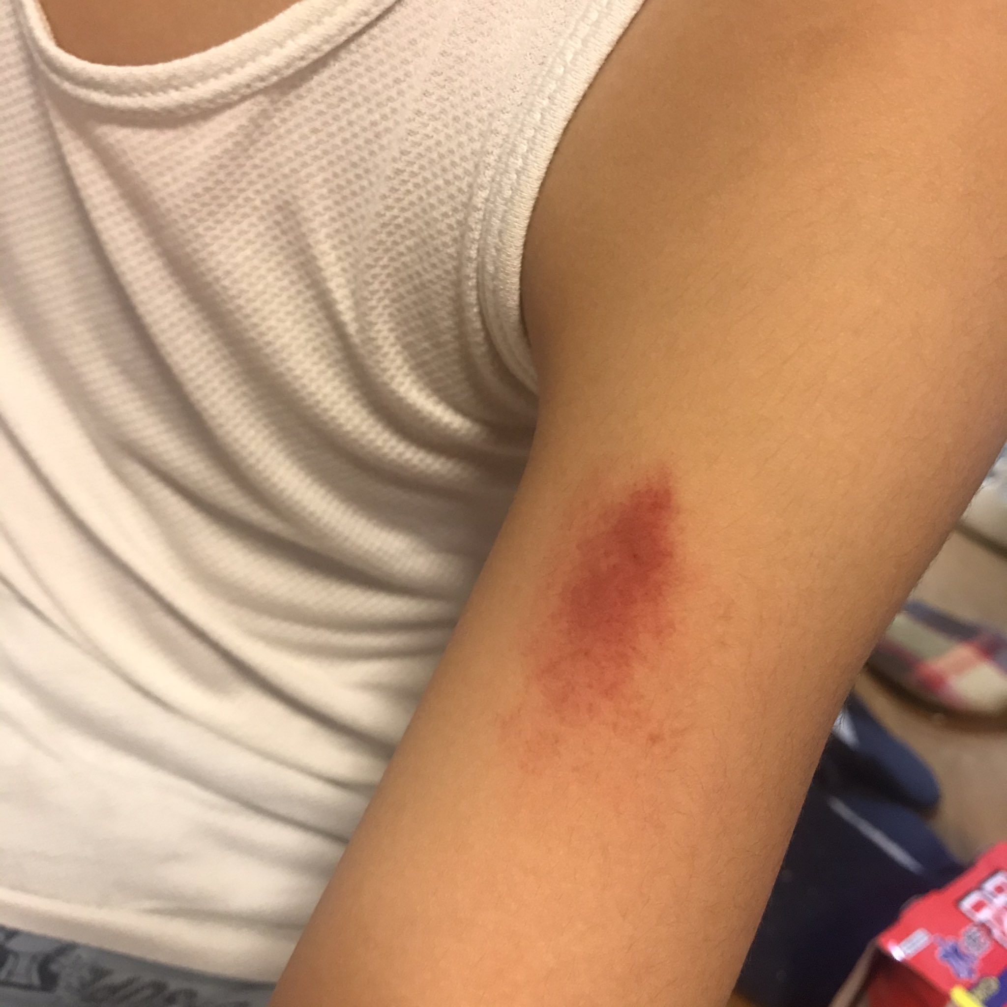 A 風沼 בטוויטר 9歳息子の腕に 謎の赤いアザができます ここ1週間で両腕に 痛くもないし 痒くもないらしいのですが なんか すごく不思議 皮膚病 アザ T Co M54oamgmsk טוויטר
