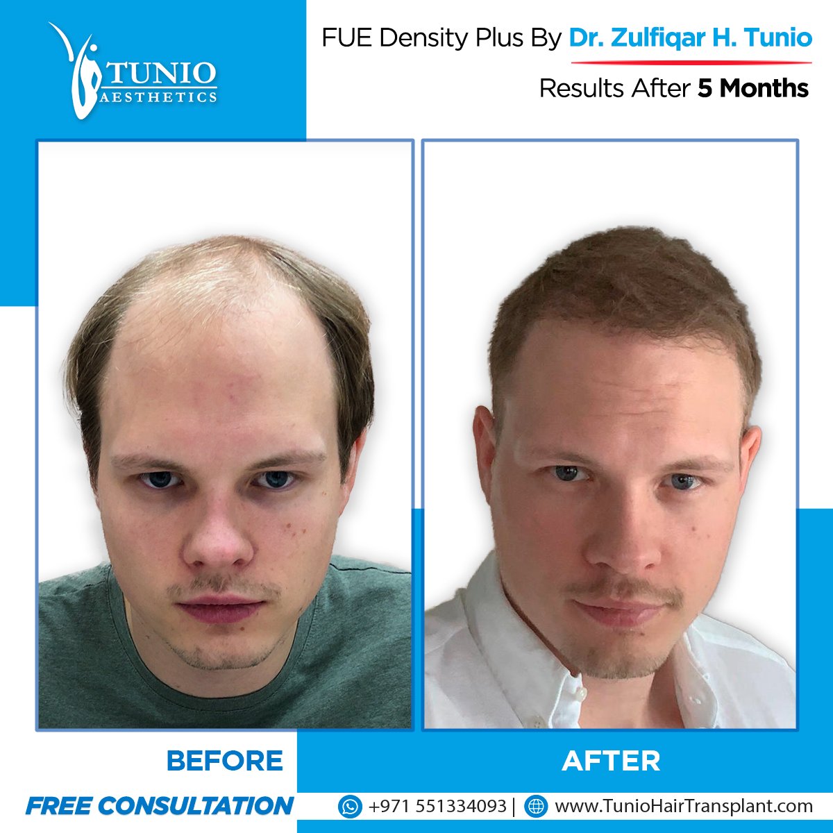 Hair Transplant Result Just in After 6 Months  Rejuvenate Hair