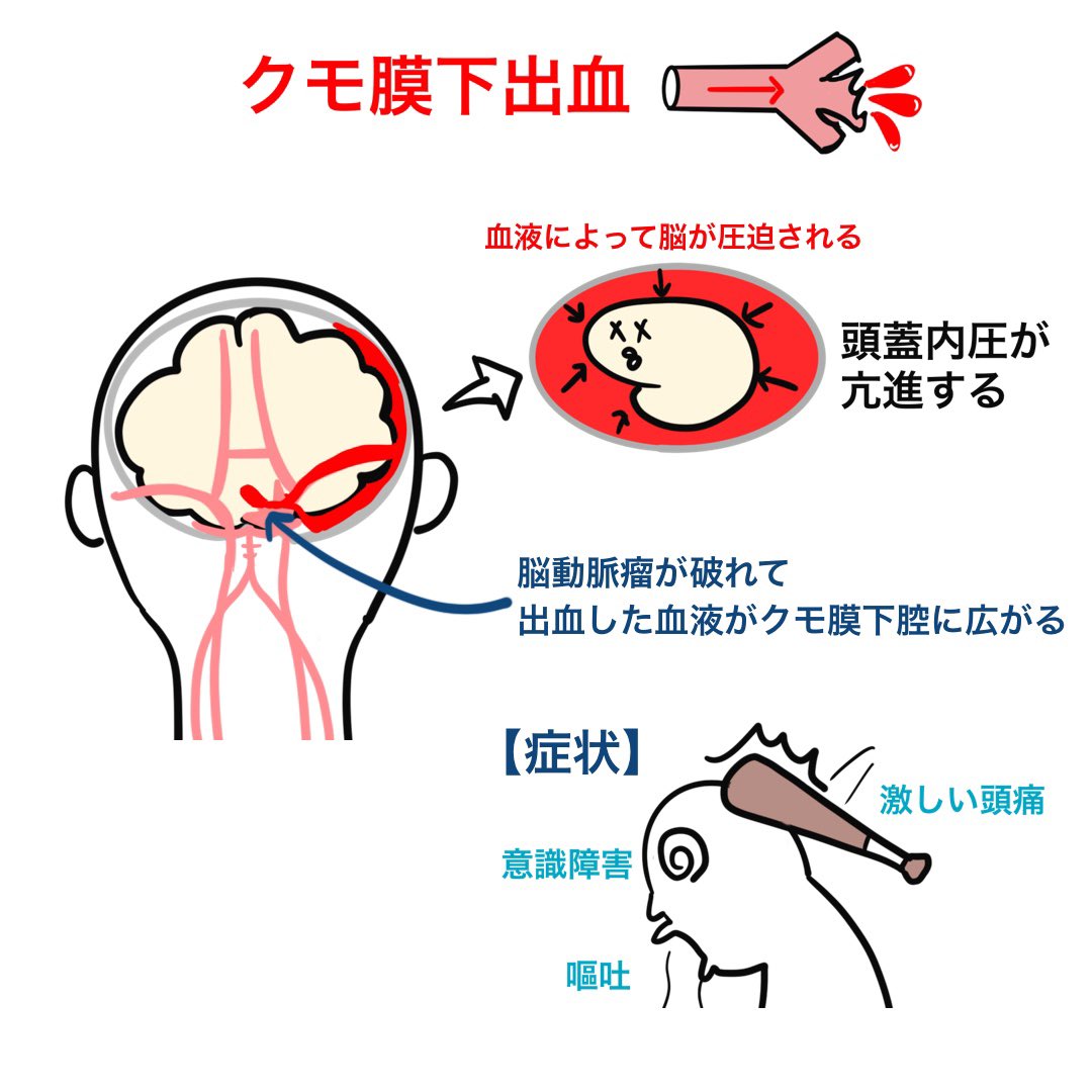 ゴロ 解剖生理イラスト A Twitter イラストで分かる 脳出血とクモ膜下出血