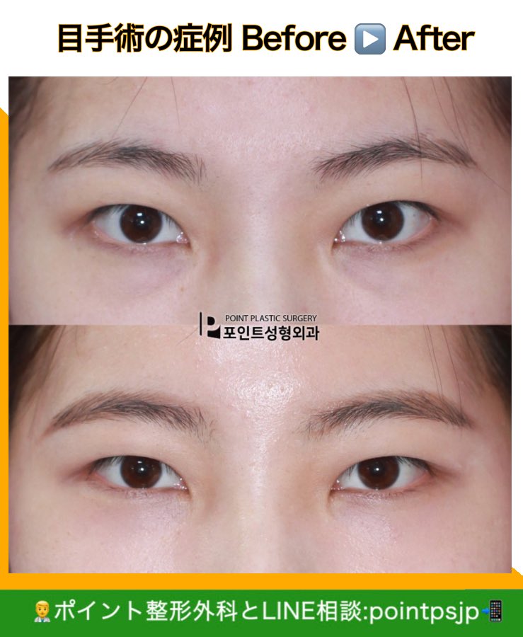 ポイント整形外科 V Twitter 朴院長が教える整形ポイント 目下脂肪再配置 暗い印象を与え 顔が疲れて見える原因になる目の下のクマ 結膜からアプローチして外側に傷跡がなく 日常生活への復帰も早いので休みが長く取れない方にもオススメです