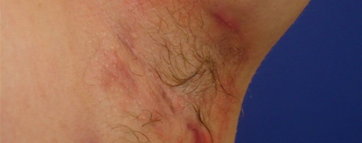 Bsfcharity On Twitter It S Hidradenitis Suppurativa Awareness Week Hs Is A Long Term Recurrent And Painful Disease In Which There Is Inflammation Redness Tenderness And Swelling In Areas Of Skin Containing Apocrine