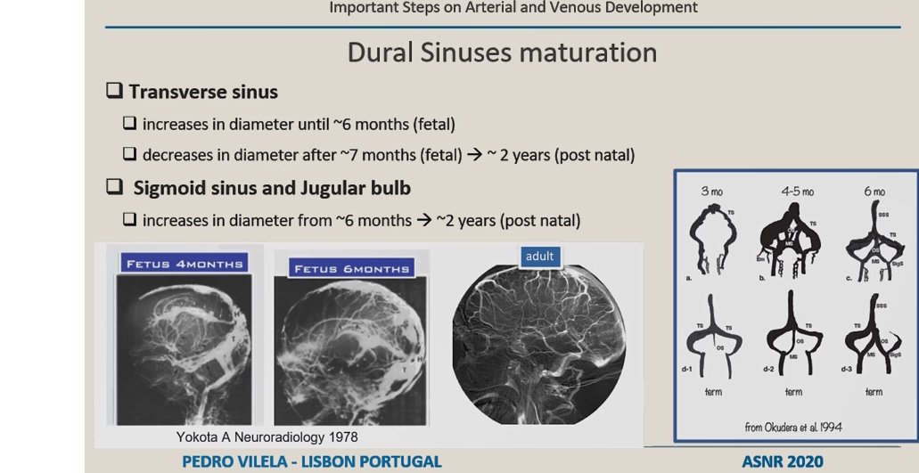 Josh Hirsch (@joshuaahirsch) on Twitter photo The Drs. Tom Naidich, Pedro Vilela combination has been #amazing in their embryologic review of the cerebral vasculature <a href="/MountSinaiCVC/">Mount Sinai Cerebrovascular</a>. Don't worry <a href="/The_ASPNR/">American Society of Pediatric Neuroradiology</a> and education <a href="/vagal01/">Achala Vagal MD, MS</a> <a href="/WendeNGibbs/">Wende Gibbs</a>, will catch the simultaneous programming soon! #distancelearning #ASNR20 The Drs. Tom Naidich, Pedro Vilela combination has been #amazing in their embryologic review of the cerebral vasculature <a href="/MountSinaiCVC/">Mount Sinai Cerebrovascular</a>. Don't worry <a href="/The_ASPNR/">American Society of Pediatric Neuroradiology</a> and education <a href="/vagal01/">Achala Vagal MD, MS</a> <a href="/WendeNGibbs/">Wende Gibbs</a>, will catch the simultaneous programming soon! #distancelearning #ASNR20