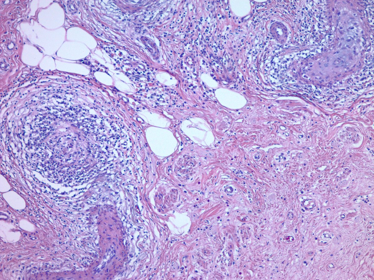 jake_bledsoe's tweet image. Appendix with lupus vasculitis. Appendectomy for presumed appendicitis. No acute appendicitis seen. Vessels within and outside of the appendix showed these changes with focal fibrinoid necrosis. Clinically and serologically active SLE. #GIpath #pathology