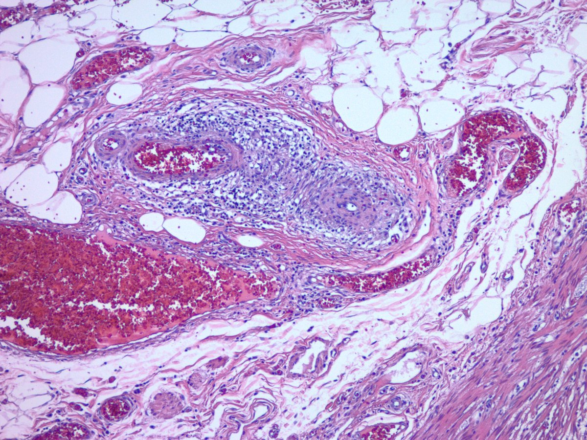 jake_bledsoe's tweet image. Appendix with lupus vasculitis. Appendectomy for presumed appendicitis. No acute appendicitis seen. Vessels within and outside of the appendix showed these changes with focal fibrinoid necrosis. Clinically and serologically active SLE. #GIpath #pathology