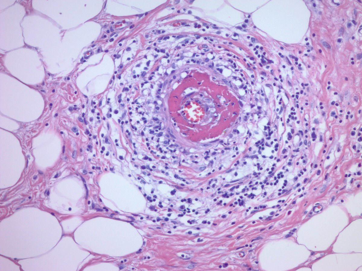 jake_bledsoe's tweet image. Appendix with lupus vasculitis. Appendectomy for presumed appendicitis. No acute appendicitis seen. Vessels within and outside of the appendix showed these changes with focal fibrinoid necrosis. Clinically and serologically active SLE. #GIpath #pathology