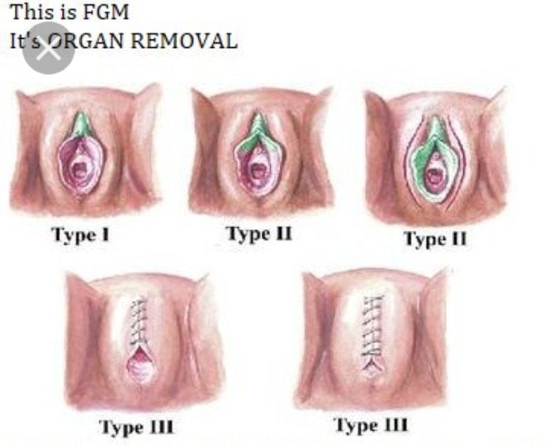 GambiaFgm's tweet photo. This is what some of us the victim of #fgm are going thurogh right now. For a survivor victim like me is going thurogh #typefive(5) that's why am looking for help everywhere to everyone who can help me please...#ENDFGM https://t.co/o334K6tPeS