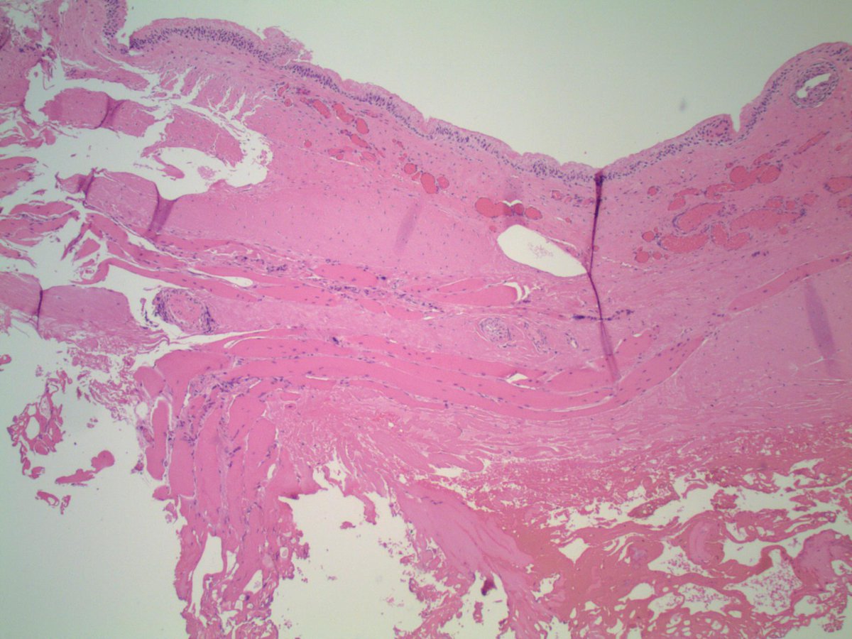 slusagar's tweet photo. #LPpath #pathstories ๐ฌ
tissue/Dx/clinical history? https://t.co/MUxpLldRIh