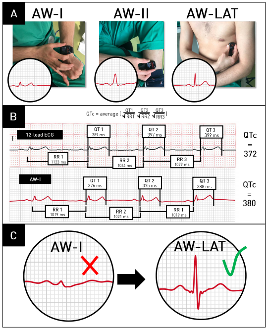 Circulation (@circaha) on Twitter photo Just Published Online: #ResearchLetter: Cardiologists from <a href="/ihu_liryc/">IHU Liryc</a> <a href="/CHUBordeaux/">CHU de Bordeaux</a> validated QT-interval measurement using the Apple Watch ECG to enable remote monitoring during the #COVID19 pandemic. ow.ly/hbSt50zVJR2 <a href="/StrikMarc/">Marc Strik</a> <a href="/BordacharPierre/">Pierre Bordachar</a> #AHACOVID19 #AHAJournals Just Published Online: #ResearchLetter: Cardiologists from <a href="/ihu_liryc/">IHU Liryc</a> <a href="/CHUBordeaux/">CHU de Bordeaux</a> validated QT-interval measurement using the Apple Watch ECG to enable remote monitoring during the #COVID19 pandemic. ow.ly/hbSt50zVJR2 <a href="/StrikMarc/">Marc Strik</a> <a href="/BordacharPierre/">Pierre Bordachar</a> #AHACOVID19 #AHAJournals