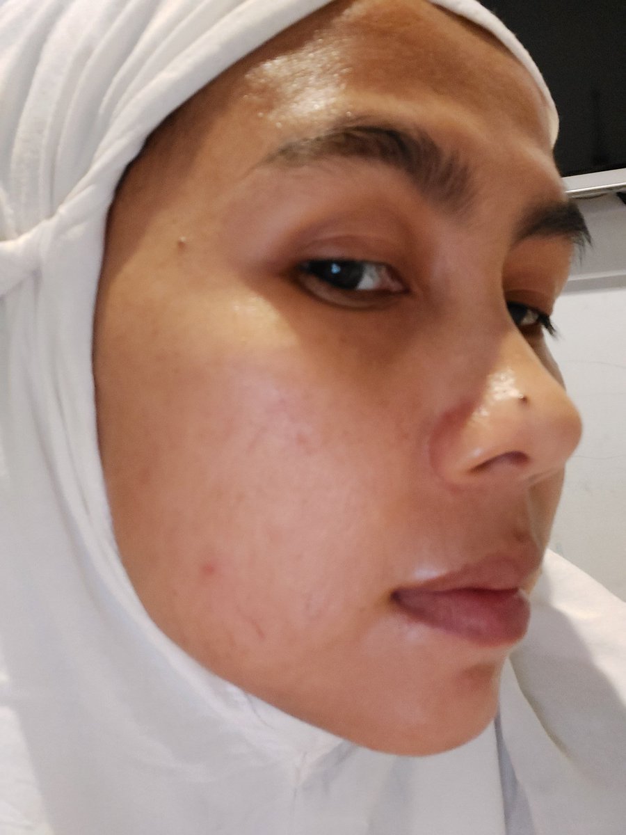 Di Ma Na On Twitter Pas Banget Pipi Kanan Kiri Lagi Jerawatan Paket Ga Skinbynofilter Dari Cintaqu Banyusadewa Sampe Inikah Yang Dinamakan Rejeki Anak Solehah Langsung Banget Ini Acne Fix Serumnya Aku Totol Totolin