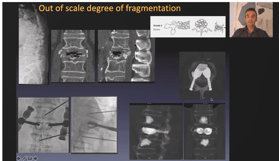 It's #SAIF--so says the remarkable Dr. Cianfoni who has now published in the #peerreview #radiology #Neurosurgery #NIR #biomechanical &amp; hopefully soon #Orthopedics #literature. The images #speak4themselves #ASNR20 @OsteoporosisNOF <a href="/Virtual_NASS/">NorthAmericanSS</a> <a href="/WendeNGibbs/">Wende Gibbs</a> #FOAMed <a href="/JohnHShinMD/">John H. Shin MD, MBA</a>