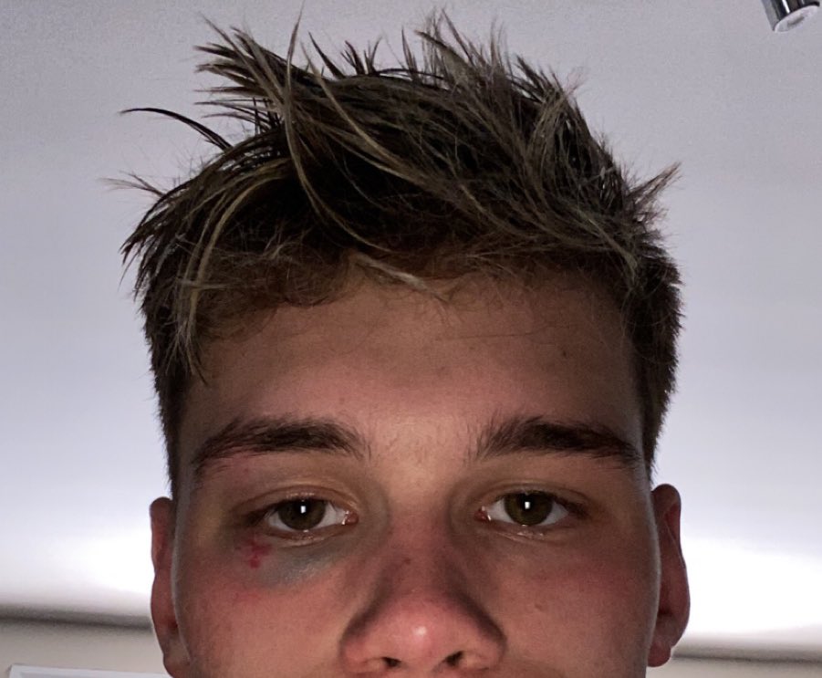 Another week under the belt! Minor injury but I can still see haha. These things happen but it shows that you shouldn’t give up! Great effort team on this weeks HITT session