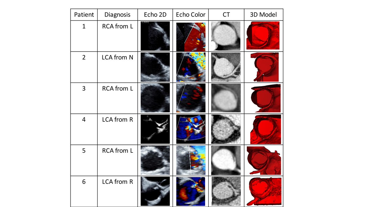Dr. Kanwal M Farooqi (@kfarooqi) on Twitter photo 🗣️Our new publication in <a href="/annalsthorsurg/">The Annals of Thoracic Surgery</a>
Assessment of anomalous coronary arteries by imagers and surgeons: Comparison of imaging modalities annalsthoracicsurgery.org/article/S0003-…
<a href="/Heart_SCCT/">Heart_SCCT</a> <a href="/AChoiHeart/">Dr Andrew D. Choi</a> <a href="/RonBlankstein/">Ron Blankstein</a> <a href="/ToddVillinesMD/">Dr. Todd C. Villines</a> <a href="/ebrosenzweig/">E B Rosenzweig MD</a> <a href="/iamritu/">Ritu Thamman MD</a> <a href="/mswami001/">Madhav Swaminathan</a>
<a href="/shubhi_srivas/">Dr. Shubhika Srivastava MBBS</a> 🗣️Our new publication in <a href="/annalsthorsurg/">The Annals of Thoracic Surgery</a>
Assessment of anomalous coronary arteries by imagers and surgeons: Comparison of imaging modalities annalsthoracicsurgery.org/article/S0003-…
<a href="/Heart_SCCT/">Heart_SCCT</a> <a href="/AChoiHeart/">Dr Andrew D. Choi</a> <a href="/RonBlankstein/">Ron Blankstein</a> <a href="/ToddVillinesMD/">Dr. Todd C. Villines</a> <a href="/ebrosenzweig/">E B Rosenzweig MD</a> <a href="/iamritu/">Ritu Thamman MD</a> <a href="/mswami001/">Madhav Swaminathan</a>
<a href="/shubhi_srivas/">Dr. Shubhika Srivastava MBBS</a>