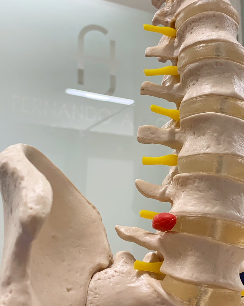 Arcadamuz's tweet photo. En esta imagen se representa una hernia discal en L4-L5
En muchas ocasiones es posible ayudar a su reabsorción,siendo  fundamental un diagnóstico preciso y un tratamiento muy personalizado
#fisio #osteopatia #salud #herniadiscal #hernia #rehabilitacion #tratamiento #desescalada https://t.co/SY0wGVSZfT