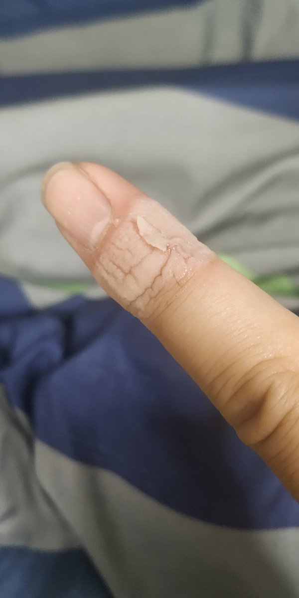 ひこたん 乾いたら今度は皮が剥けてくるよ そうなるから俺は最近は出血してなければバンドエイドは巻かずに水絆創膏を使ってるよ ひこたん 乾いたら今度は皮が剥けてくるよ そうなるから俺は最近は出血してなければバンドエイドは巻かずに水絆創膏を使ってるよ