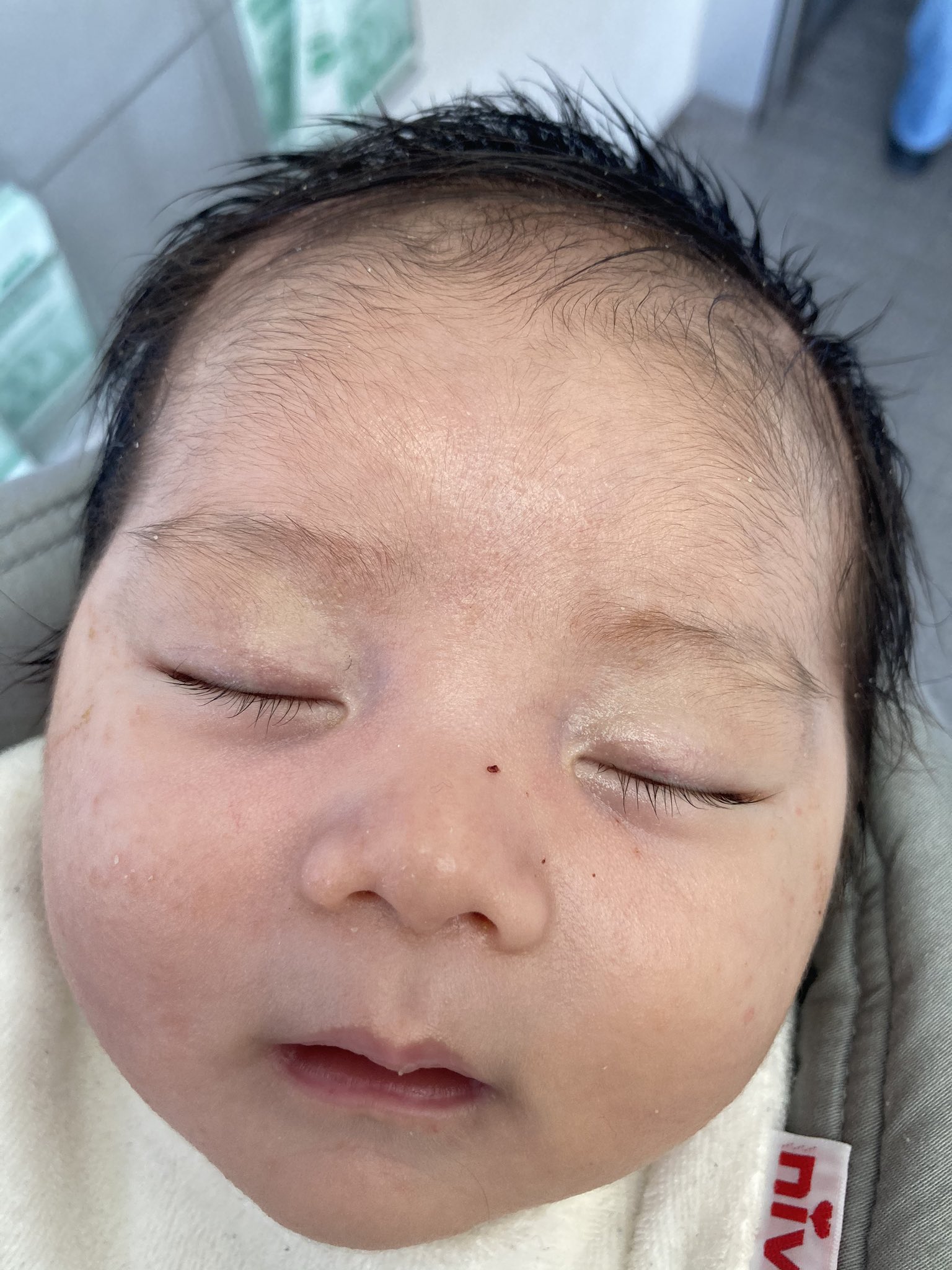じゃが On Twitter 上の子よりかなりひどい乳児湿疹 真っ赤に腫れ上がっててしまってる 本当は2ヶ月くらい様子見ても良いけど 耳あたりがじくじくとしてきたので 明日小児科へ行く 多分 上の子と同じアトピー肌やろなぁ ステロイドで早く治してあげたいな