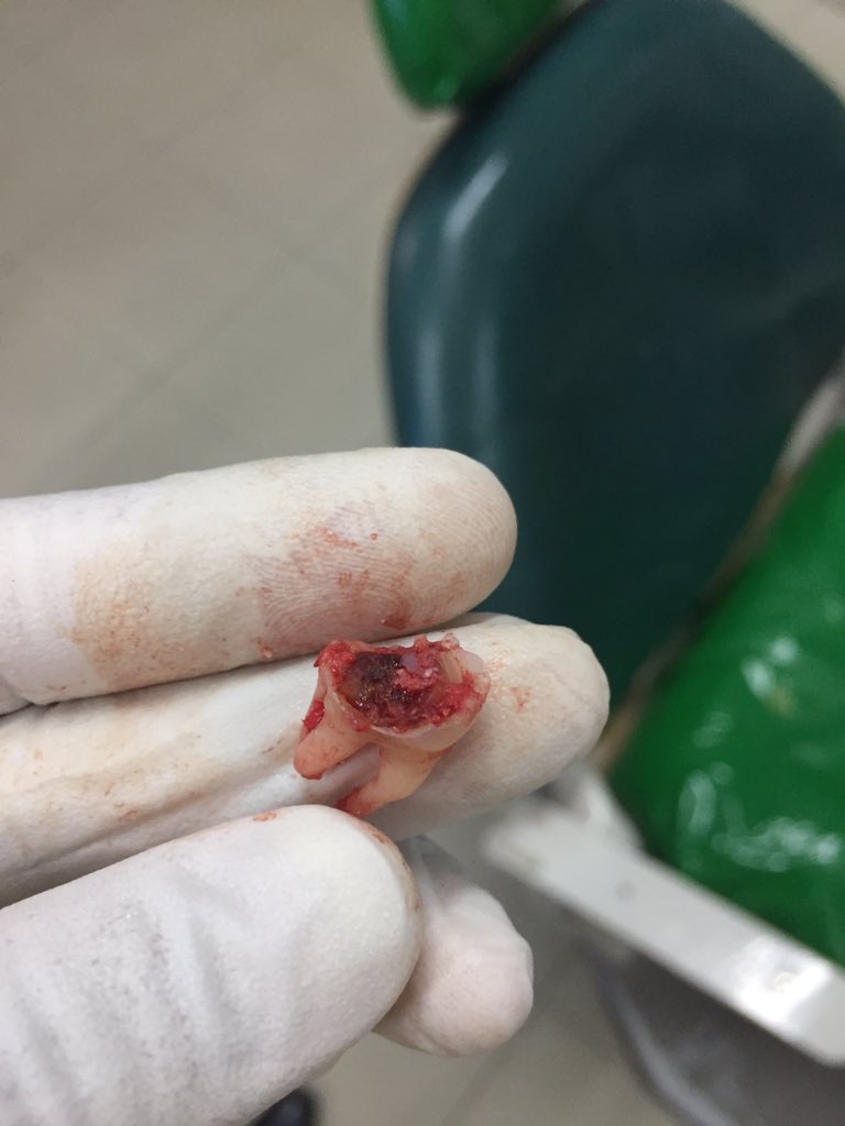 naqib_salleh's tweet photo. Hasil pancingan harini ! #toothcollector #dentistry https://t.co/tOp8d4vW3g