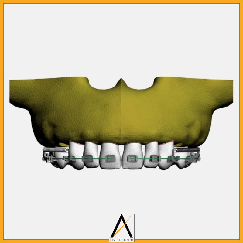 aytasarim's tweet image. Çalışma Adı: Üst kanin distalizasyonunda oluşan değişikliklerin sonlu eleman analizi ile incelenmesi
Doktor Adı: İlknur Veli
#implantoloji #finiteelement #biyomedikal #3d #implant #3dmodelling #cad #computeraideddesign #dentist #dentistry #allonfour #computerguided
