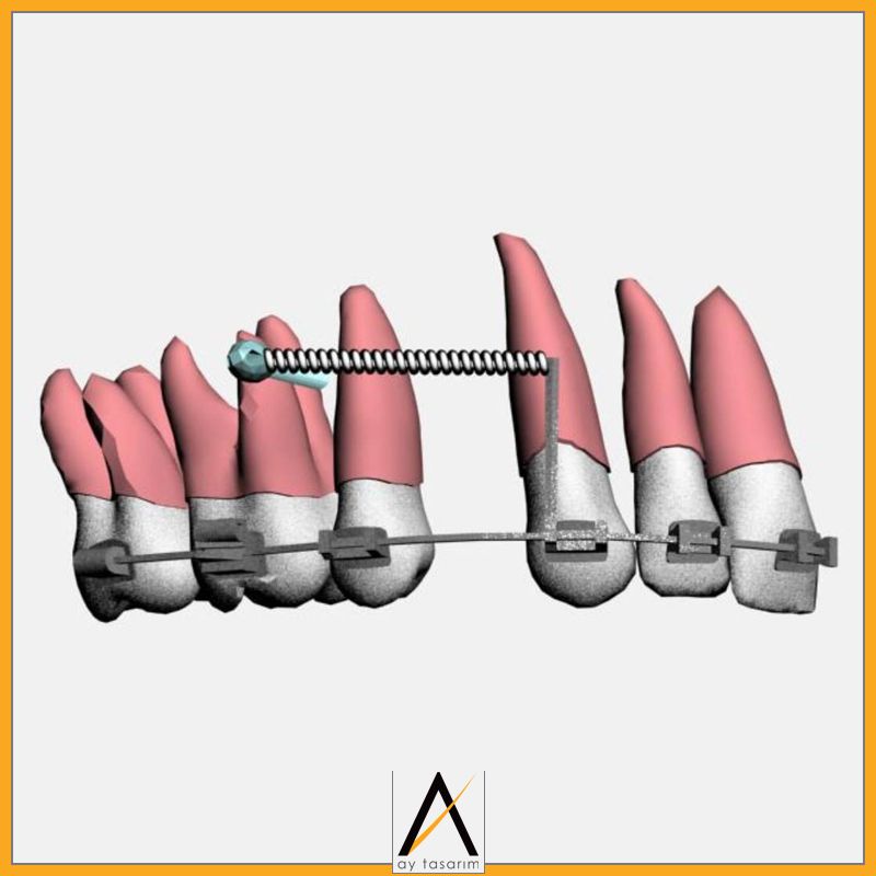 aytasarim's tweet image. Çalışma Adı: Üst kanin distalizasyonunda oluşan değişikliklerin sonlu eleman analizi ile incelenmesi
Doktor Adı: İlknur Veli
#implantoloji #finiteelement #biyomedikal #3d #implant #3dmodelling #cad #computeraideddesign #dentist #dentistry #allonfour #computerguided