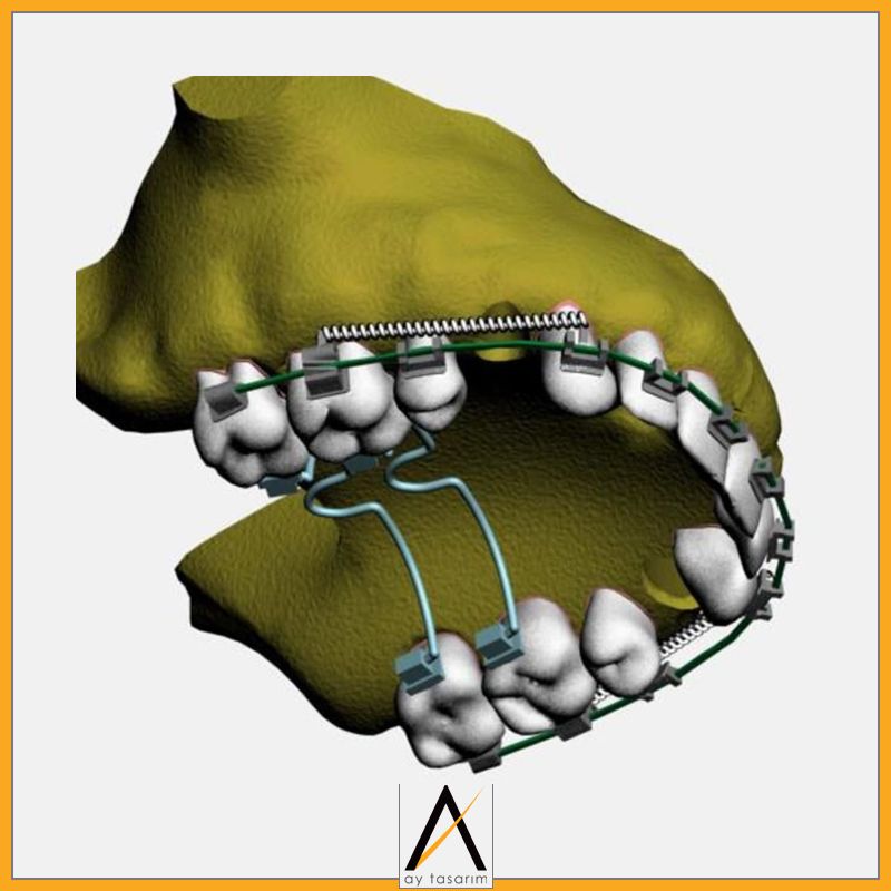 aytasarim's tweet image. Çalışma Adı: Üst kanin distalizasyonunda oluşan değişikliklerin sonlu eleman analizi ile incelenmesi
Doktor Adı: İlknur Veli
#implantoloji #finiteelement #biyomedikal #3d #implant #3dmodelling #cad #computeraideddesign #dentist #dentistry #allonfour #computerguided