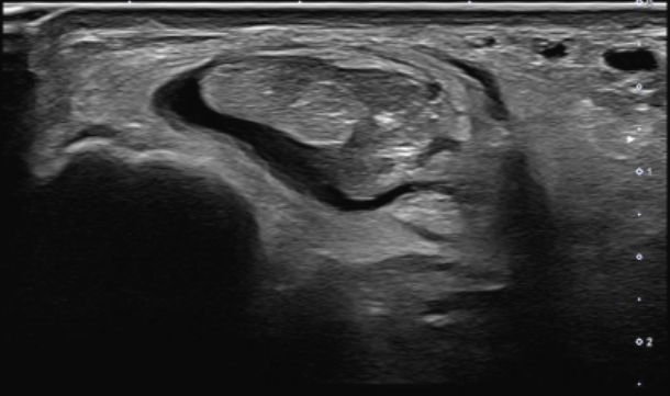 NEW WEEKLY CASE
Male 53y, trekking. Left ankle sprain 2 months ago, inversion mech, and rupture feeling, no functional impairment, no hematoma. Ankle brace as unique treatment. Now pain lateral ankle with trekking, sharp with quick relief: Complete rupture peroneus brevis tendon.