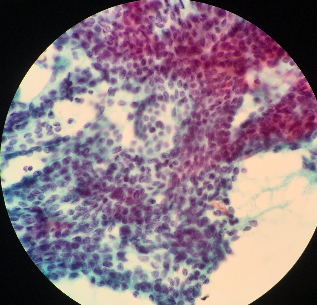 TCytologist's tweet photo. Case on working today,rainy day  Male 52yrs. FNA Mass at neck.💉💉 🔬🔬🦠🦠 #cytology  #papstain #cytopatho #cytopath  #cytotechnologist #cytologists https://t.co/UqLce9NGYY