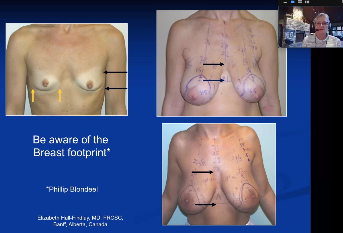 ASJrnl's tweet photo. Live NOW with @banffplasticsurgery - "Be Aware of the Breast Footprint" - check out her markings. https://t.co/dGT1c2NCki