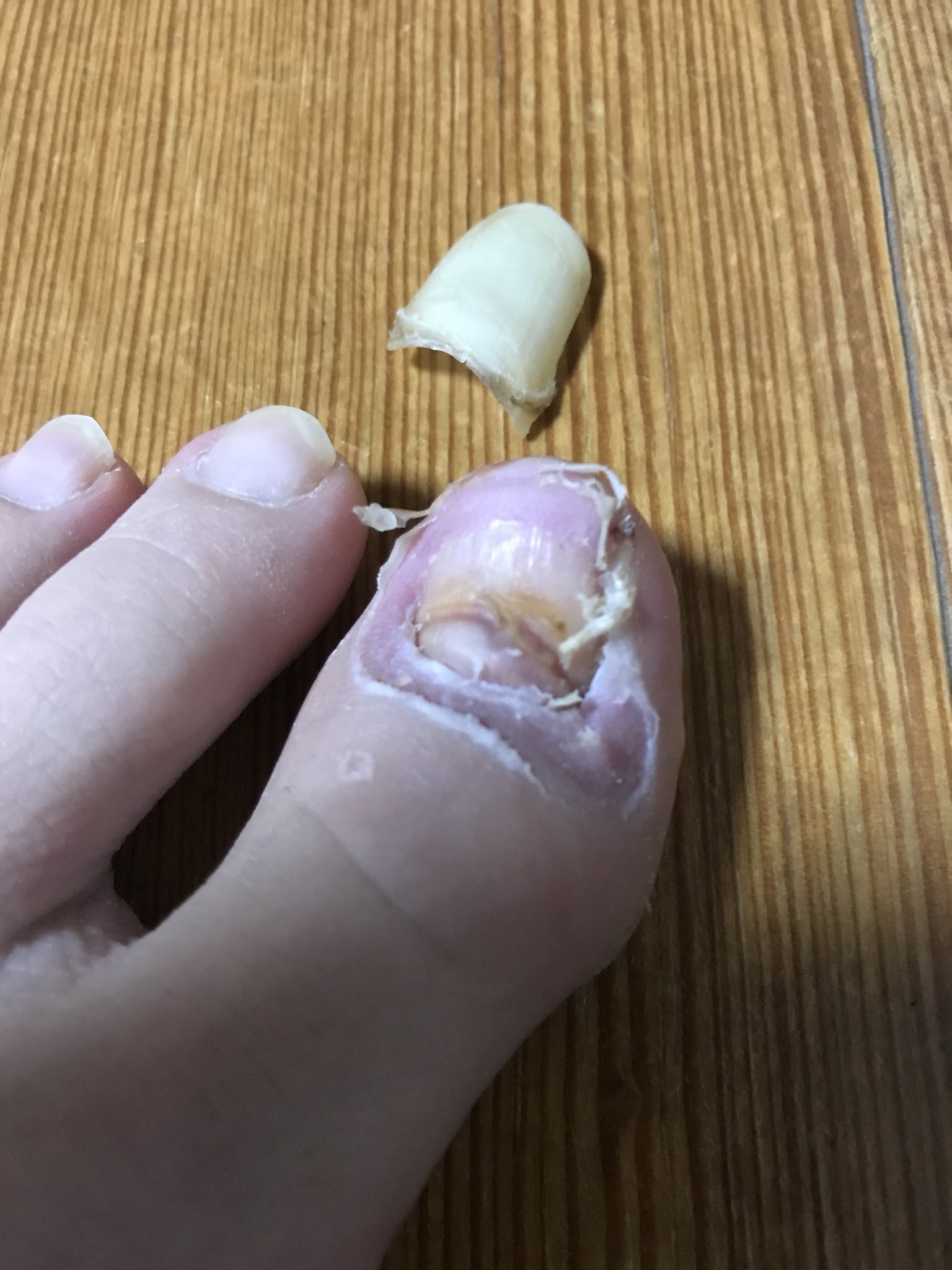 きたりぃ 閲覧注意 汚い 足の爪 足の親指の爪 ついに取れた 指キモイ T Co Islh7dvbbl Twitter