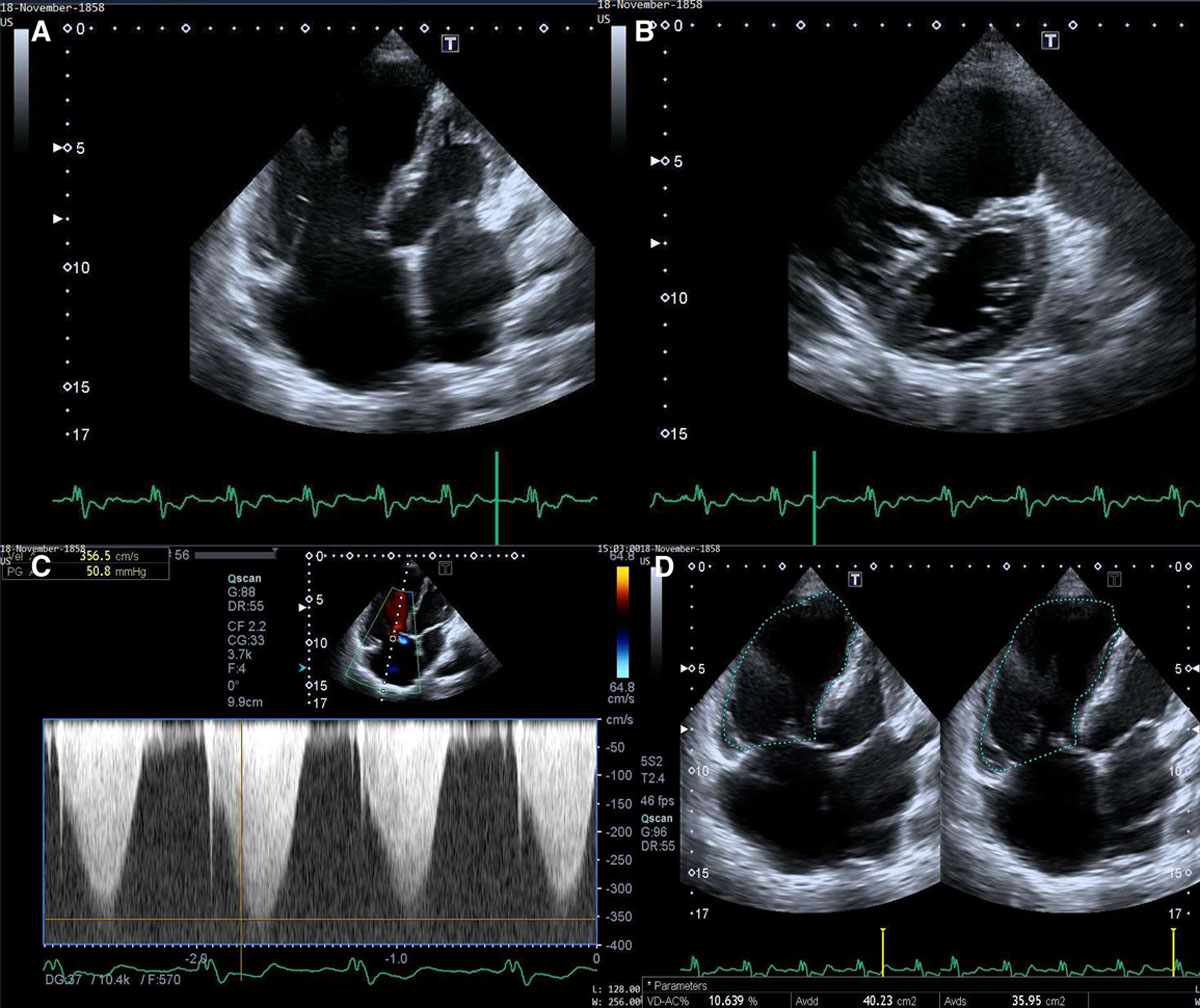 Example of the importante of early referral of GUCH patients in specialized Center! #GUCH <a href="/AntonioMariaLe2/">Antonio Maria Leone</a> <a href="/cardiopedhnn/">Jorge Faerron</a> <a href="/CyntiaMachain/">Cyntia Machain</a> <a href="/lucreciamburgos/">Lucrecia M. Burgos, MD</a> <a href="/AlsaiedTarek/">Tarek Alsaied</a>
<a href="/JSabatino86/">Jole Sabatino</a> <a href="/AlexFrogoudaki/">Alexandra Frogoudaki</a>

doi.org/10.1161/CIRCIM…