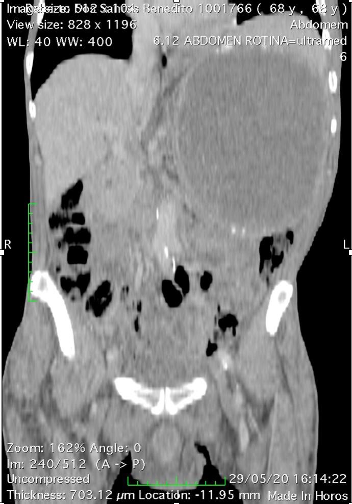 MarcoAu1957's tweet photo. 68 yo, male, with 6 mo history of a vague abdominal discomfort . CT: huge hydronephrosis on LK, suggesting pyonephrosis. Open nephrectomy was performed through a subcostal transperitoneal/lombar incision.Congrats @andregarbim @felipekasuya https://t.co/4hoEIXz8s8