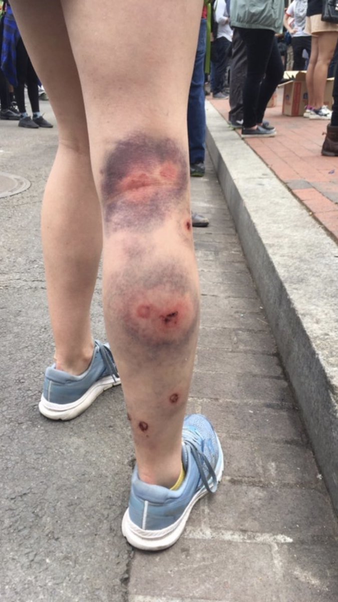 To the debate over whether rubber bullets were used outside the White House last night, here is the leg of a woman who told me she was protesting last night, back on Lafayette Square today