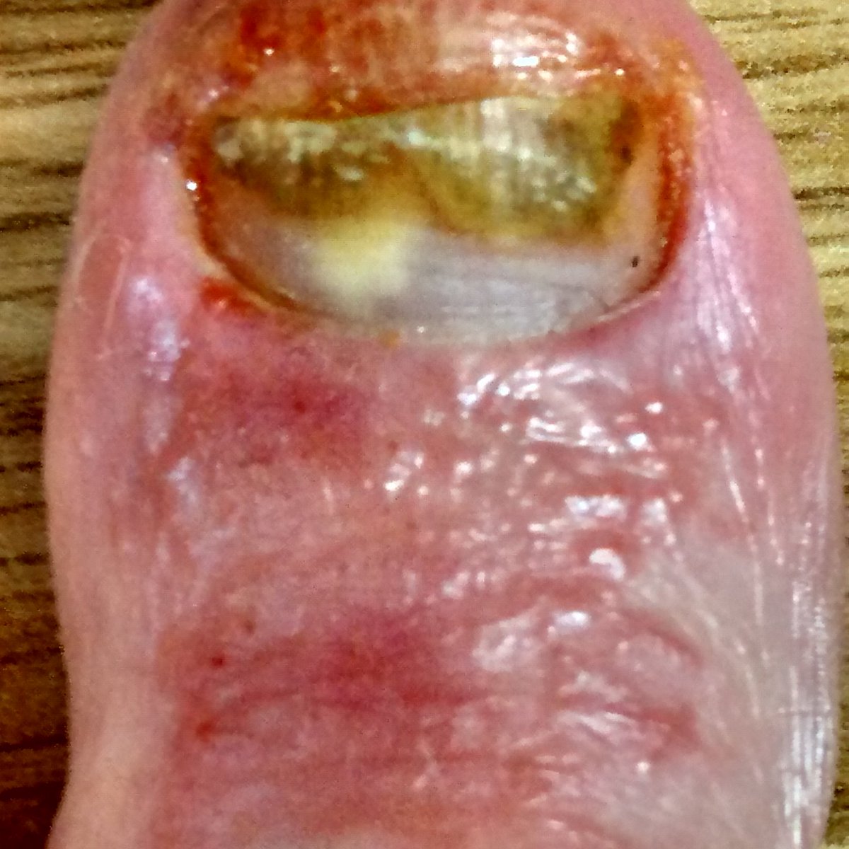 earwig_46's tweet photo. mixing an ointment using Epsom salts w/ glycerine + tea tree oil isn't a good idea 
*caution for gross picture* https://t.co/ZLxoFmb2qe