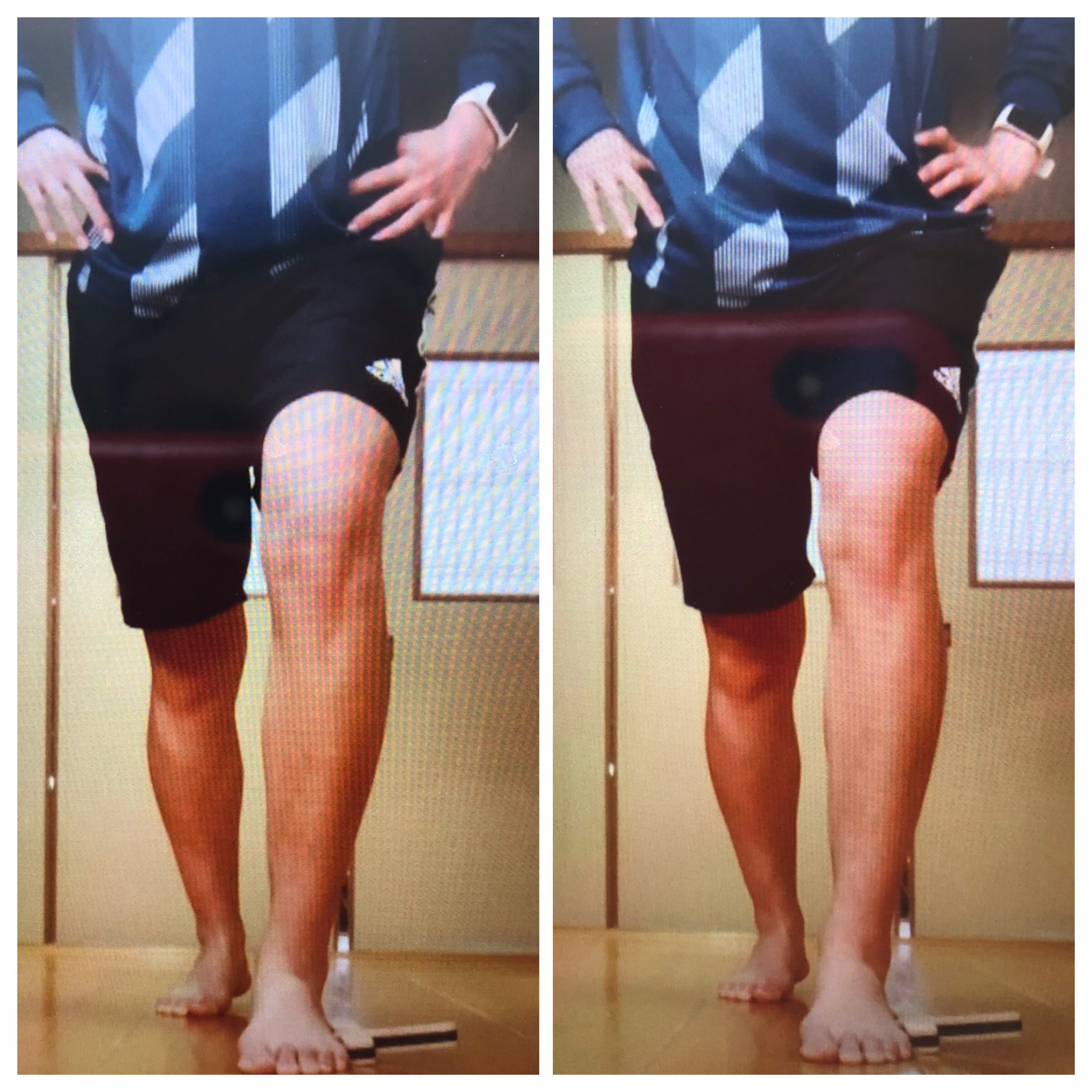 アシカラ改善院 埼玉県杉戸町 Knee Inは膝の位置だけで見てはダメです 股関節と膝 の皿 拇趾示趾間の位置関係によって判断した方が良い そして ニーインを起こさない様に だけの注意より ニーインが起きない使い方 を理解する方が回復が早い