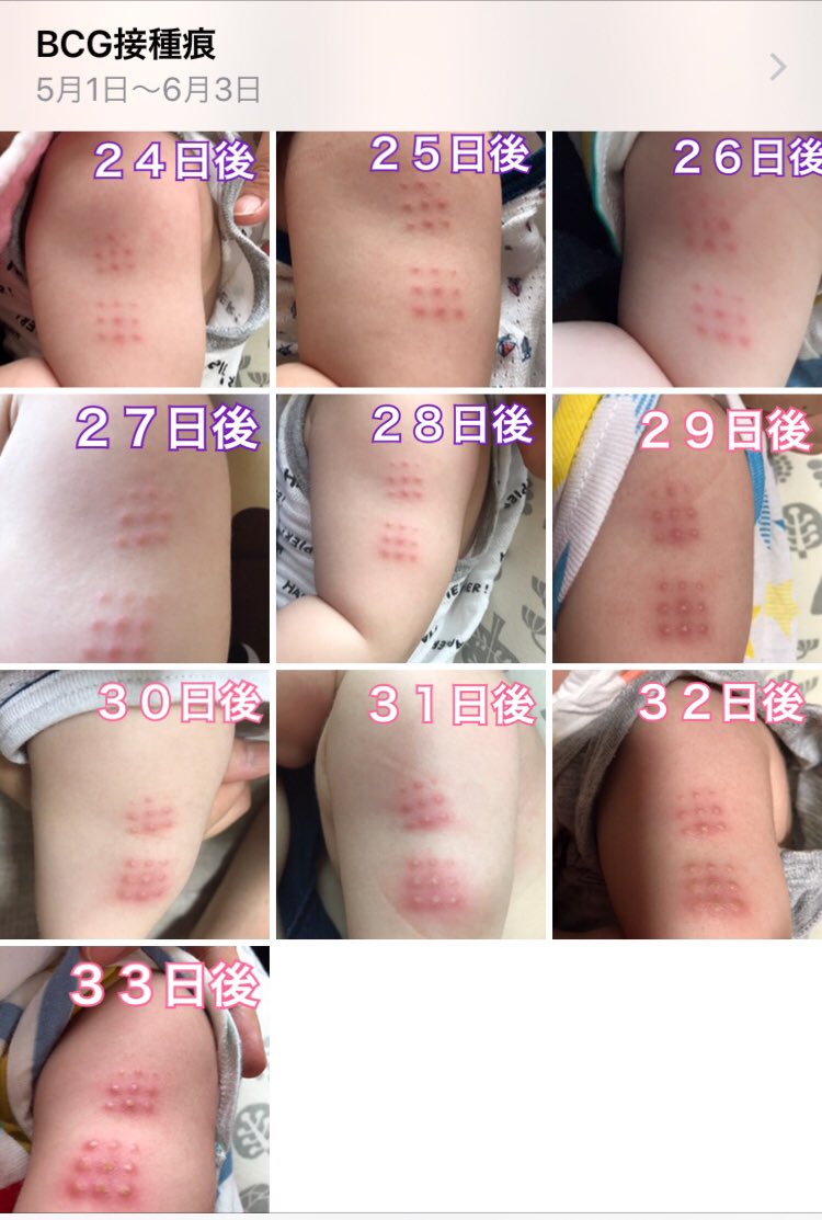 ぴっぴ 3y g接種痕 の経過ってみんなどんな感じ 次の日 赤くなってたから不安になったし 毎日記録残してる 今 1番ひどくなってて白い芯みたいなのが見える 見た目痛そう この経過が正しいのか不安になってきたよ よかったら教えてー