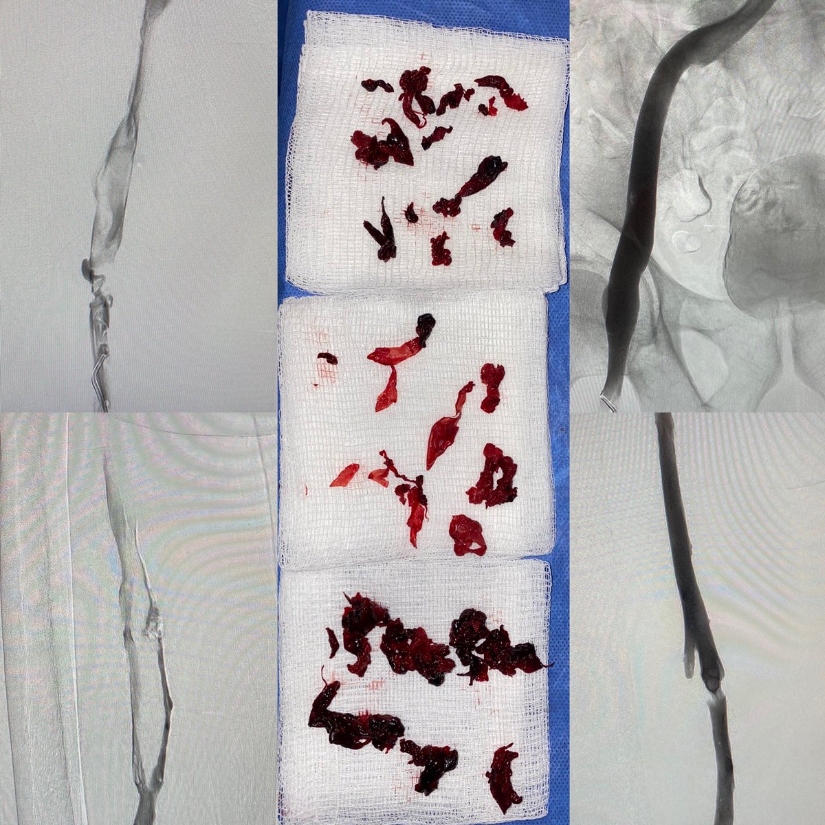 LLE dvt in a patient with stage 4 lung cancer.  SO much clot. Single session treatment. @InariMedical #ClotTriever #notpa