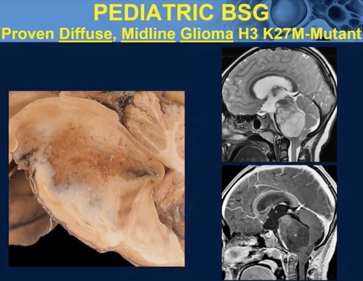 Eloquent lectures today on brain tumors by Dr. Anne Osborn. Her lectures at AFIP and book on cerebral angio convinced me to become a neuroradiolgist. Remember her Medussa hair visual for venous angioma? @JoshuaAHirsch @SusanPalasis @TYPoussaintMD @rhwiggins @AmyKotsenas #ASNR20