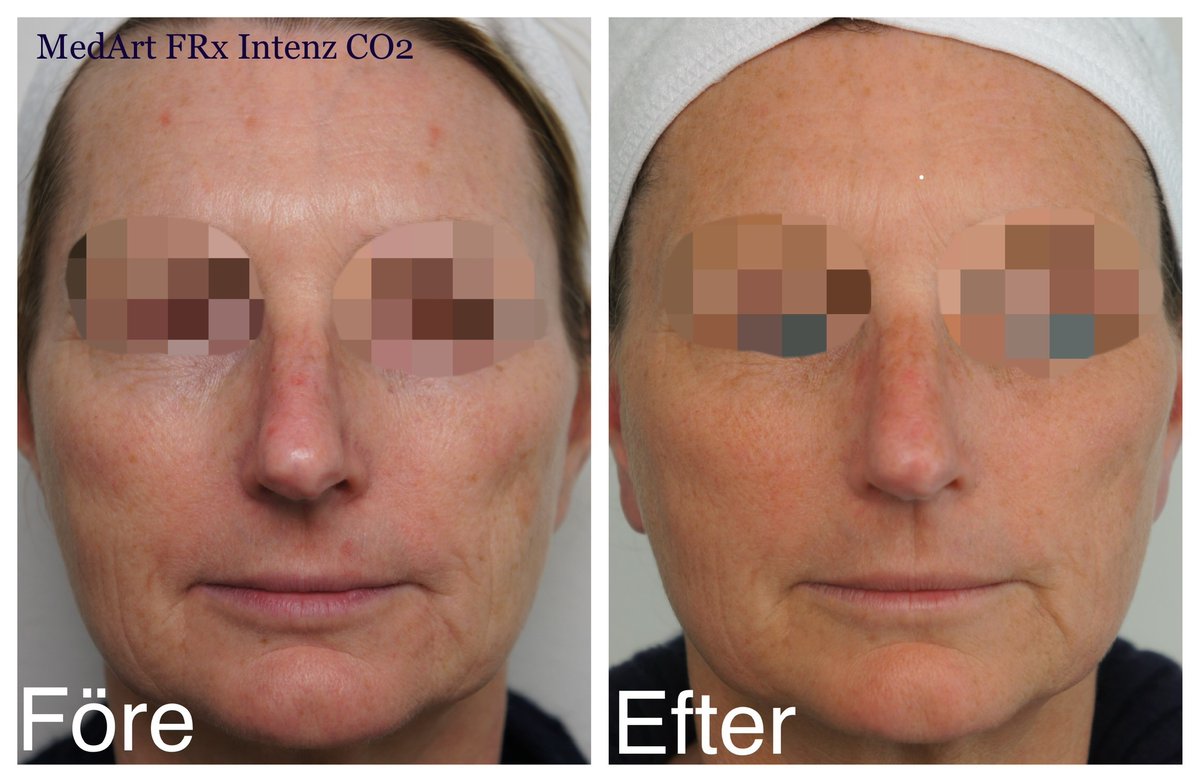 a_medart's tweet photo. Laser Treatment of Sun Damaged Skin. 
One time treatment by MedArt FRx Intenz CO2@doctorryskinclinic 👍👏💐
After photo is the result after one month👍  Read more: 
https://t.co/UGp7TxwGIv

#medartlasermanufacturing #fractionallaser #fractionalco2laser https://t.co/fG8Kf8kqZy