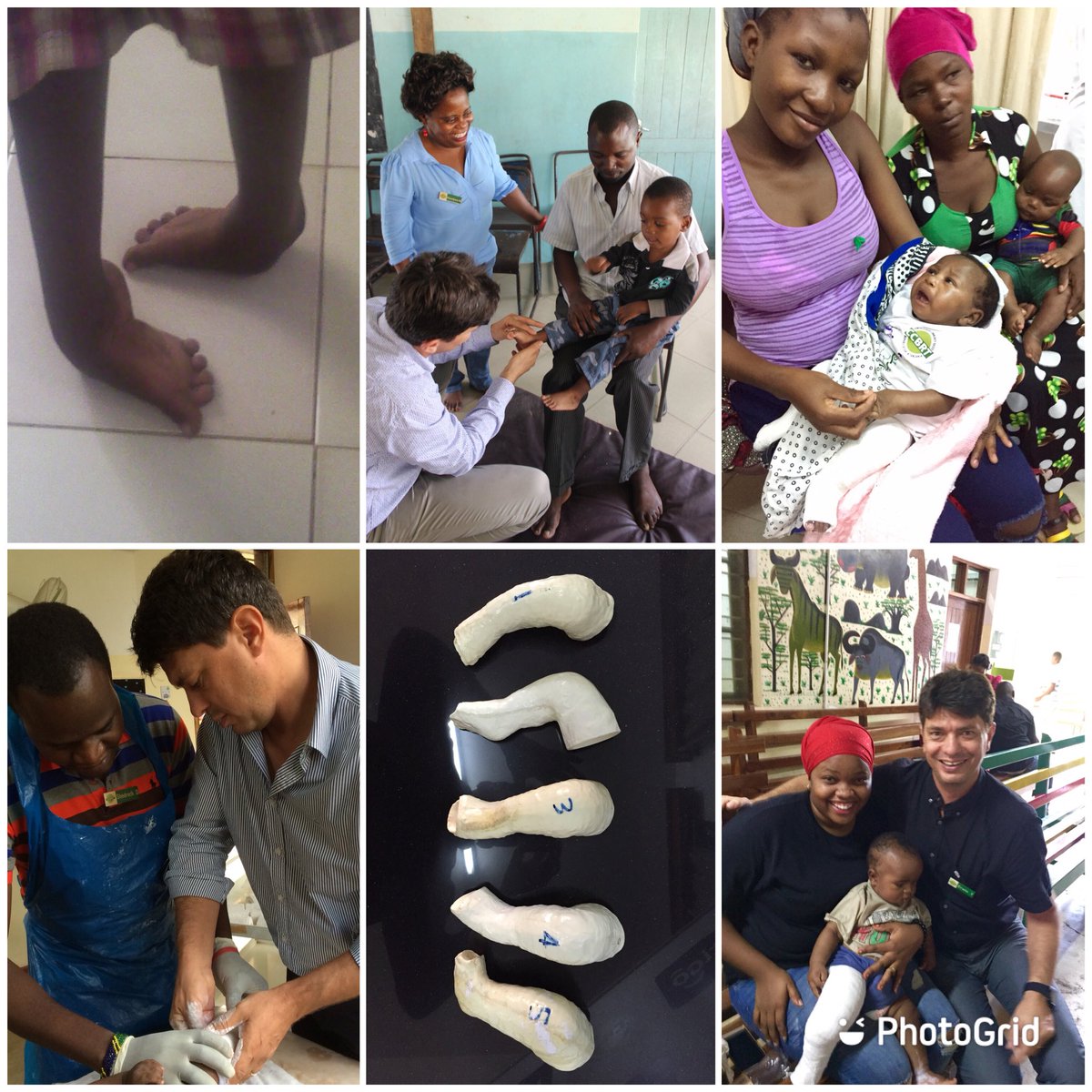 #WorldClubfootDay
Every yr 200k babies are born w clubfoot - 80% of these in low & middle income countries. 
If left untreated #clubfoot leads to severe disability - therefore early detection, #Ponseti treatment & proper follow up are critical.