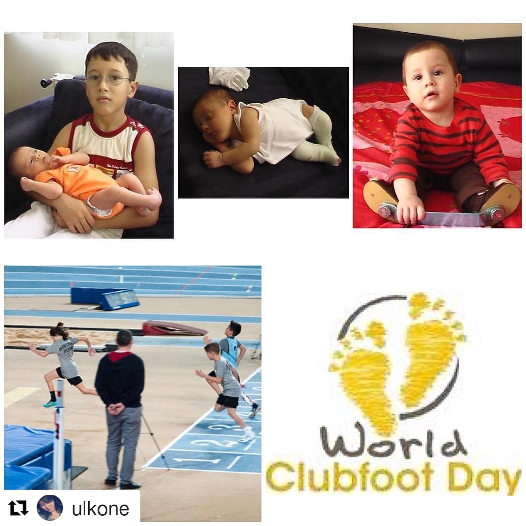 #Dünyapesekinovarusgünü #worldclubfootday
3 Haziran Dünya Pes Ekinovarus Günü kapsamında bu yıl etkinlik düzenleyemedik ama bu, 1000 çocukta bir görülen bu hastalığın, kader olmadığını anlatmamıza engel değil. Dr. Ponseti sayesinde, 1950lerden beri başarıyla tedavi edilebiliyor.