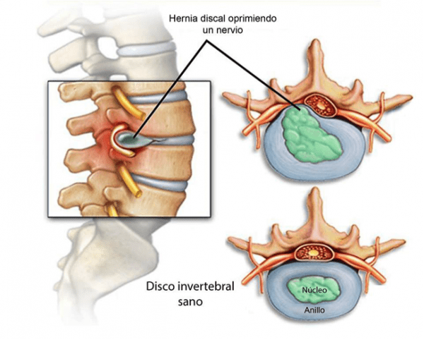 terapiamanualUE's tweet photo. De 587 hernias, 380 se reabsorbieron espontáneamente. ¿Cómo debemos informar al paciente con una hernia lumbar?
- Las hernias no siempre duelen
- Su hernia puede reabsorberse sola
- El tratamiento conservador debe ser la primera línea de tratamiento
https://t.co/FgRWFMkEhB https://t.co/qCB9vBY8rB
